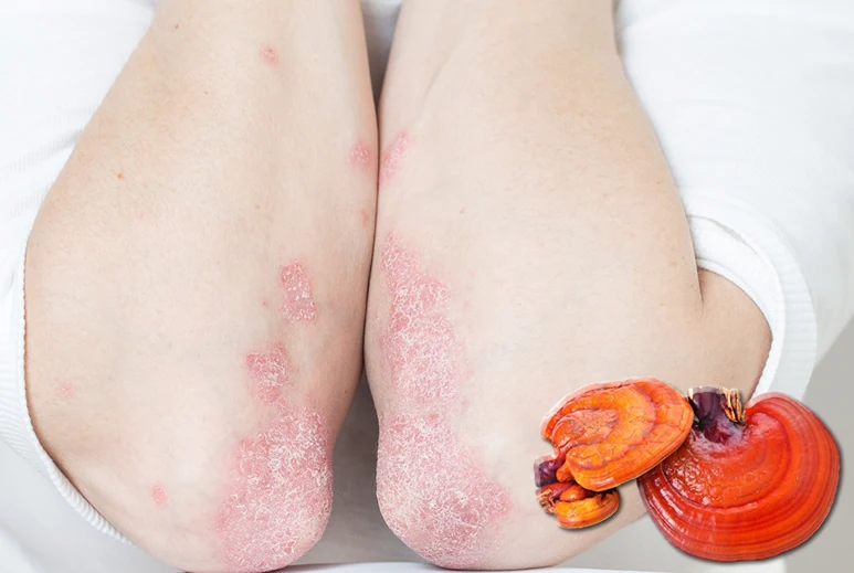 ganoexcelshop-gano-excel-manitari-ganoderma-lucidum-kata-psoriashs